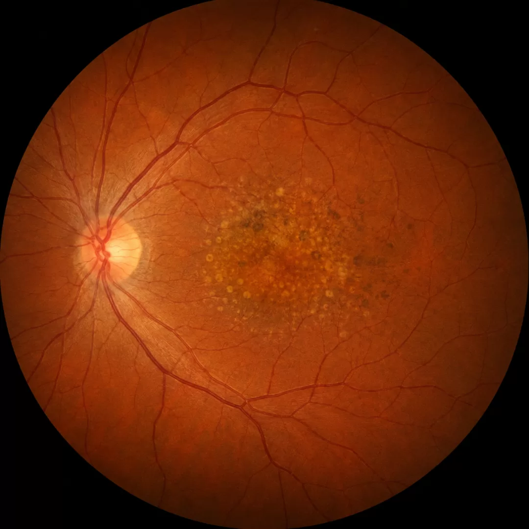 Retinografia ilustrativa com alterações compatíveis com degeneração macular relacionada com a idade