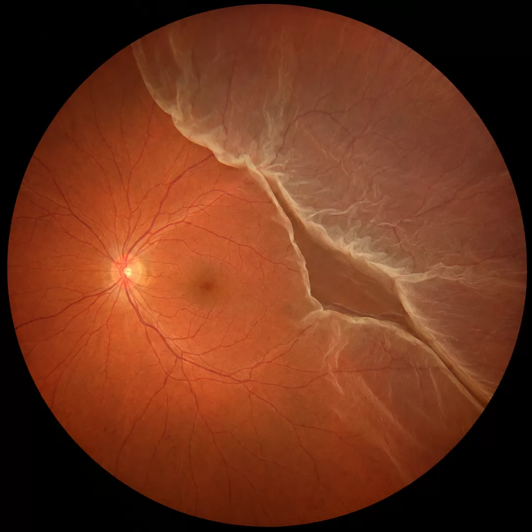 Retinografia ilustrativa com sinais compatíveis com descolamento da retina