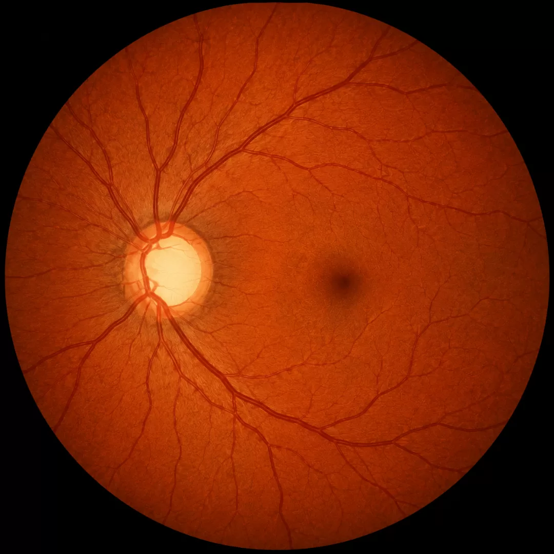 Retinografia ilustrativa com alteração do nervo ótico compatível com glaucoma