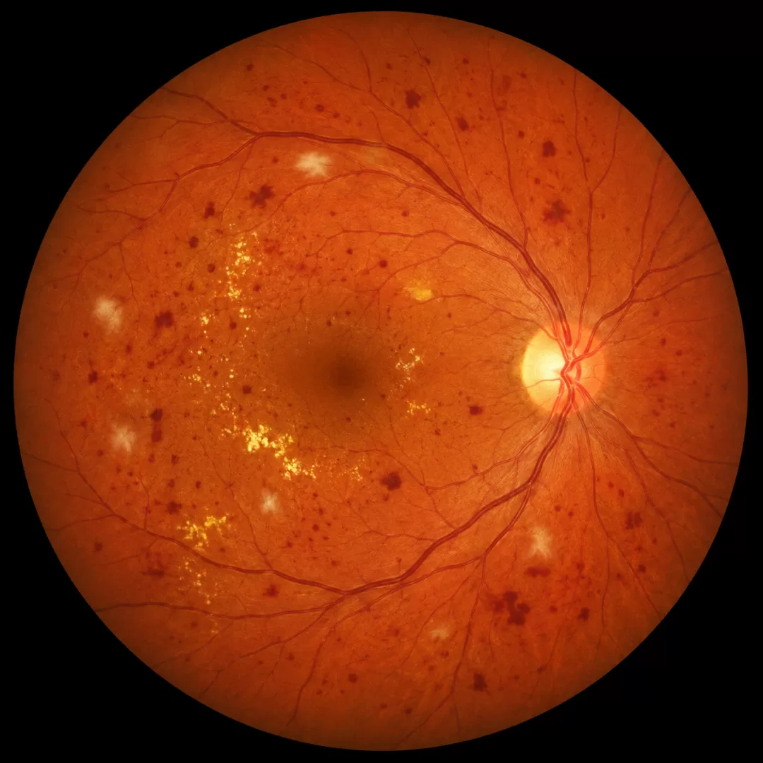 Retinografia ilustrativa com sinais compatíveis com retinopatia diabética