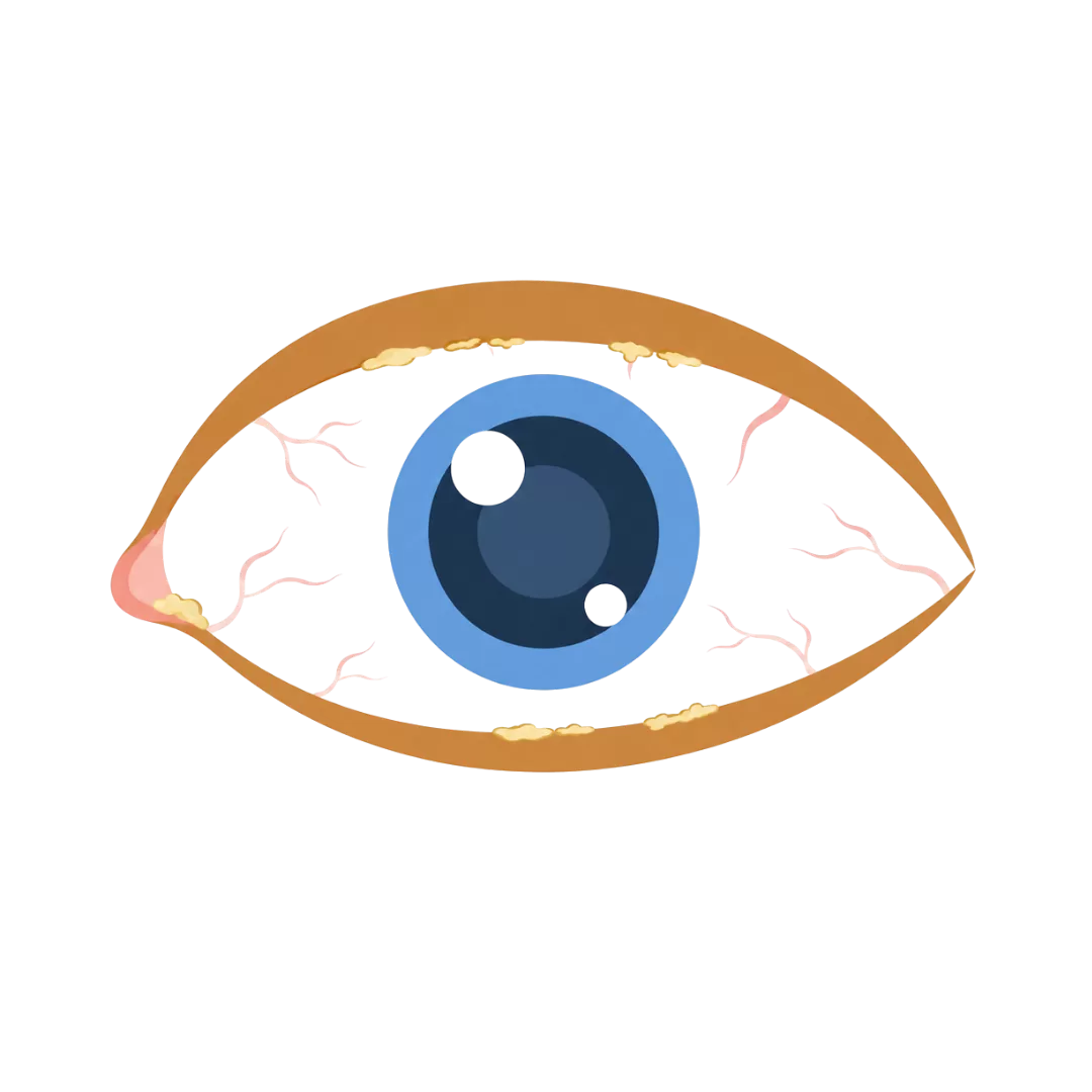 Ilustração de um olho com secreções e resíduos nas margens das pálpebras